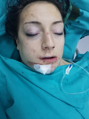 Başına halter düşen Beyzanur, 2,5 ay sonra katıldığı şampiyonada 'mucizevi sporcu' oldu(Galeri)