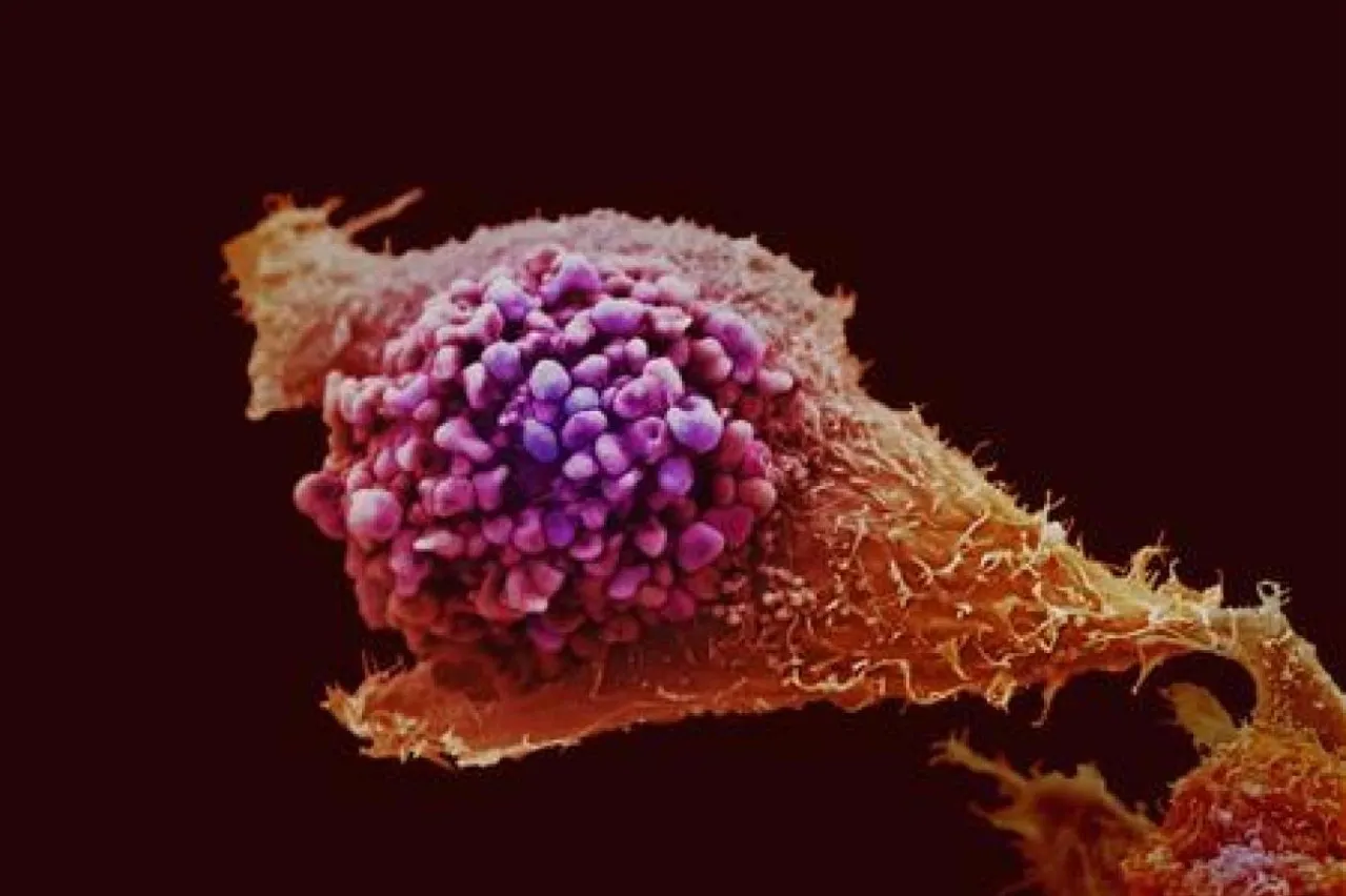 Prostat kanseri taramasında devrim: Yeni test alternatifi!