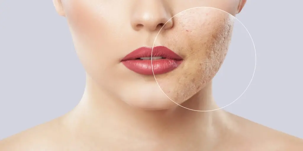 Sivilce izleri nasıl geçer? Dermatologlar açıkladı!