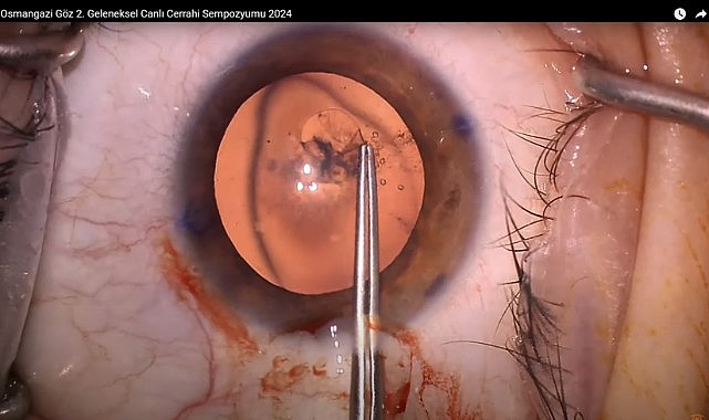 Canlı Yayında Göz Ameliyatı Yapıldı